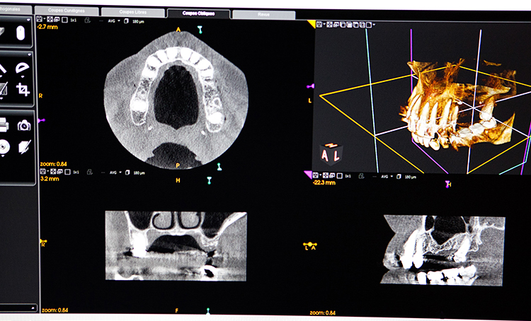 歯科用CTによる精密検査