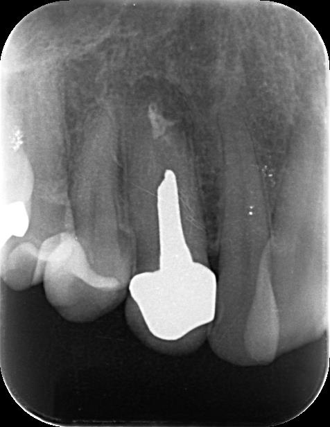 歯根端切除を行った例