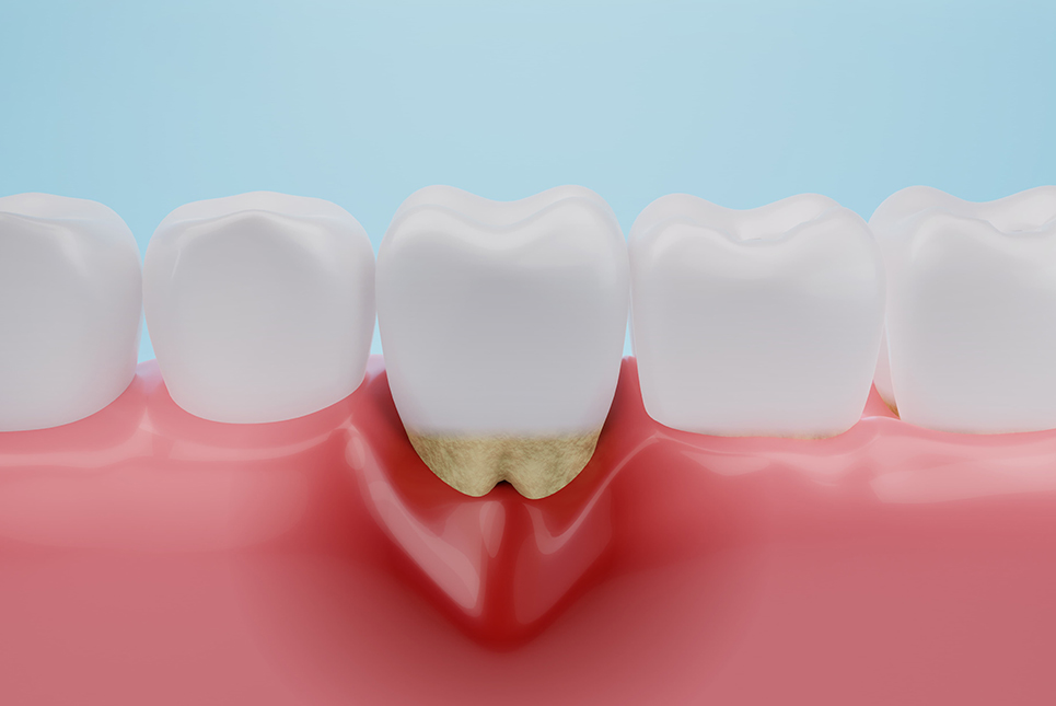 精密歯周病治療