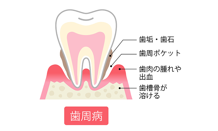 歯周ポケット奥深くの歯石除去のも可能