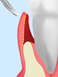 歯肉弁根尖側移動術（APF）