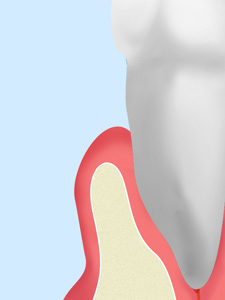 歯肉弁根尖側移動術（APF）