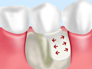 GTR法（歯周組織の再生）