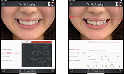 デジタルによる理想のスマイル診断